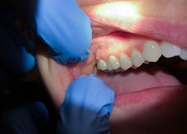 Best Dental Abscess Treatment in Northwest Harbor, NY